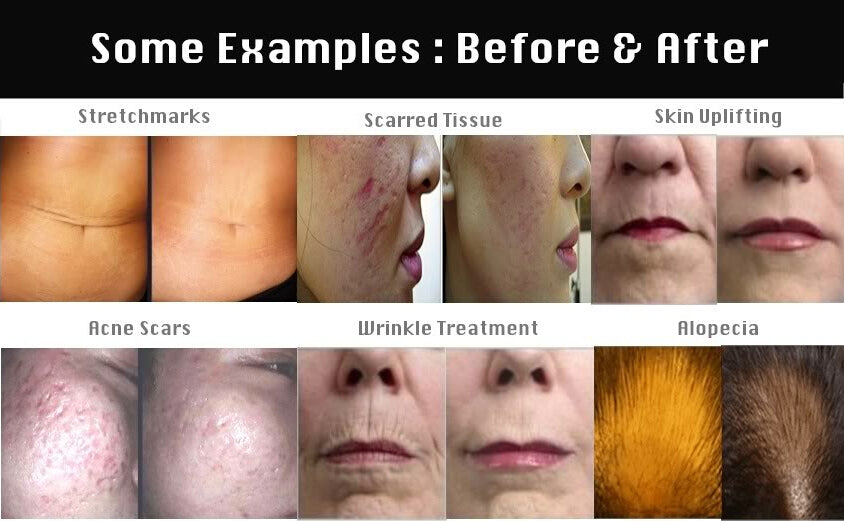 Dr. Pen A9 Ultima wireless Microneedling DermaPen