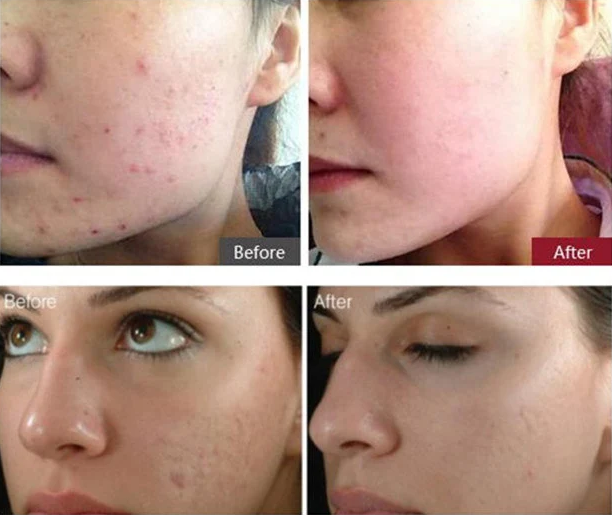 Dr Pen A6 microneedling treatment results skin rejuvenation